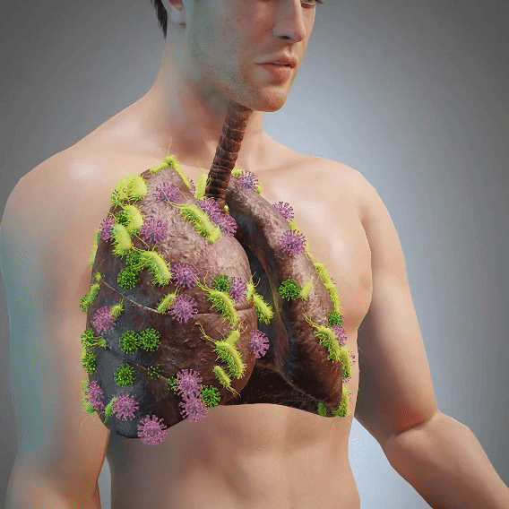 Animated conceptual illustration of lungs; not a demonstrated effect of Balanlogy